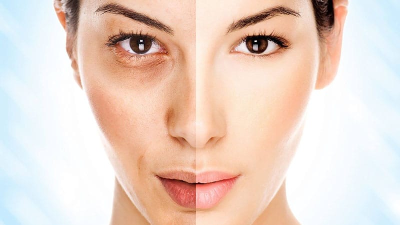 revlite-laser-treatment