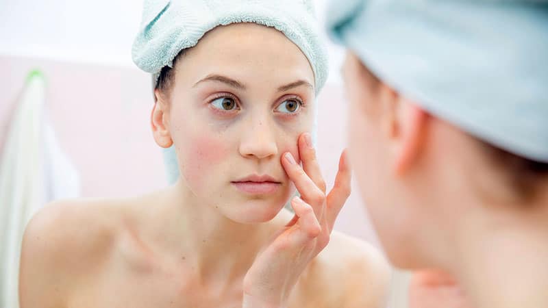 What Causes Dark Circles