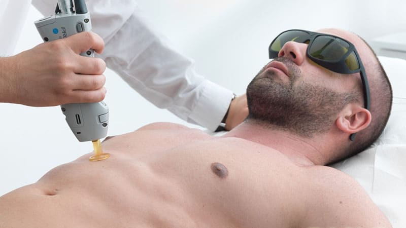 Laser Hair Removal