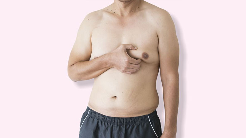 Gynecomastia Vs Pseudogynecomastia