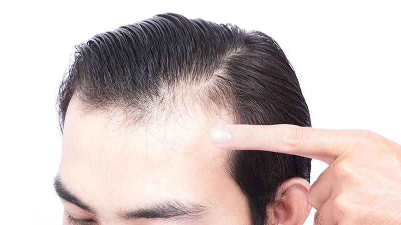 Young Man Serious Hair Loss Problem For Health Care Medical And