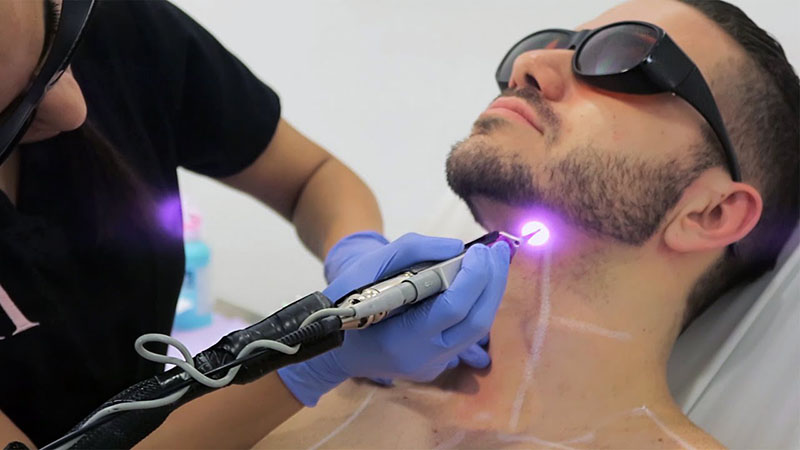 Laser Hair Removal