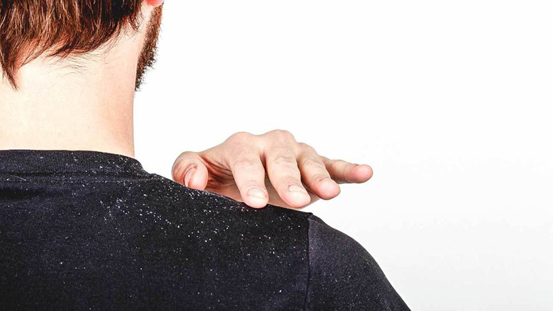 How to Get Rid of Dandruff Fast - The Trend Spotter How to Get Rid of Dandruff Fast - The Trend Spotter
