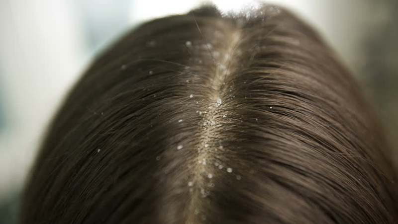 Types Of Dandruff And Causes