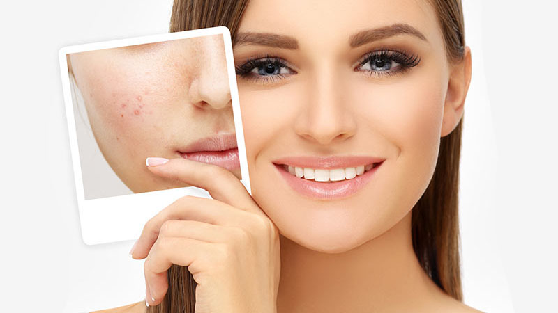 Acne Scars