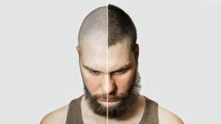 Man Before And After Hair Loss, Transplant On Background