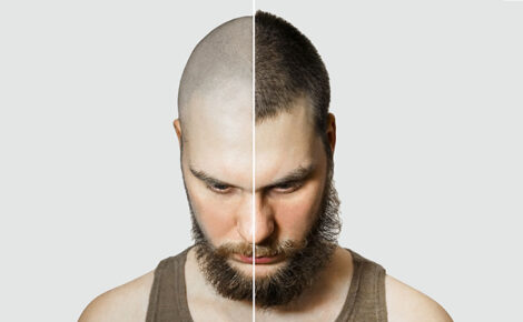 Man Before And After Hair Loss, Transplant On Background