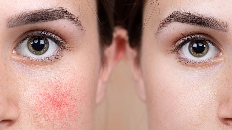 Niacinamide For Acne, Rosacea, Redness