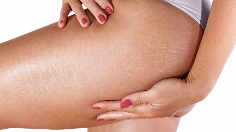 What Causes Stretch Marks